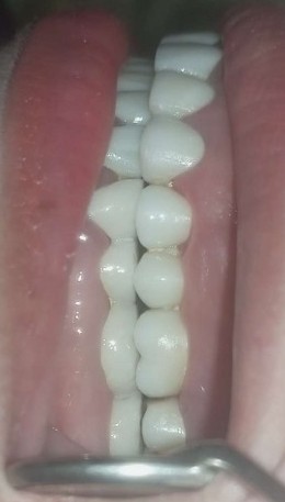 Case 01 after zirconia crown treatment at Dental Valley