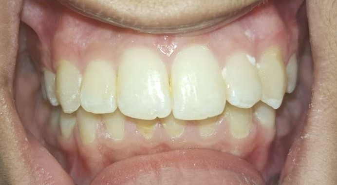 Case 02 after braces treatment at Dental Valley