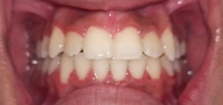 Case 03 after braces treatment at Dental Valley