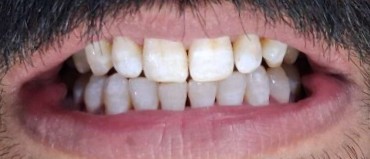 Case 04 after whitening treatment at Dental Valley