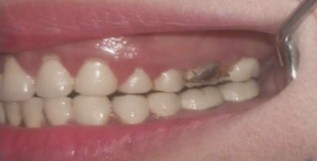 Case 01 before zirconia crown treatment at Dental Valley