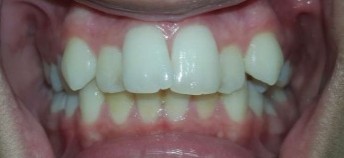Case 02 before braces treatment at Dental Valley