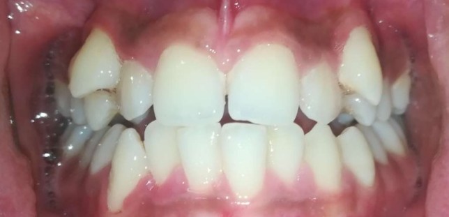 Case 03 before braces treatment at Dental Valley