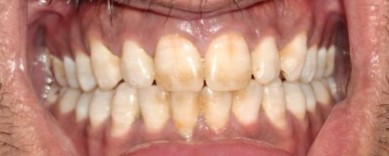 Case 04 before whitening treatment at Dental Valley