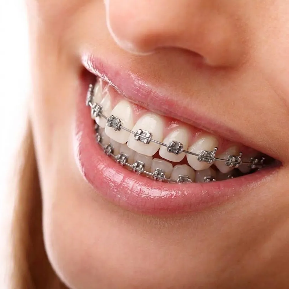 Close-up of a smile with metal braces on the upper and lower teeth