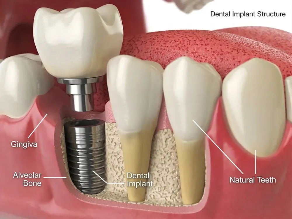 Diagram of a dental implant — titanium post, abutment and crown — set in the jawbone beside natural teeth